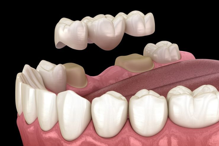 Dental-Bridges