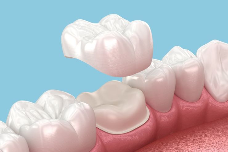 Dental-Crowns