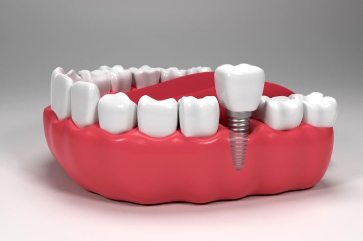 Dental-Implants