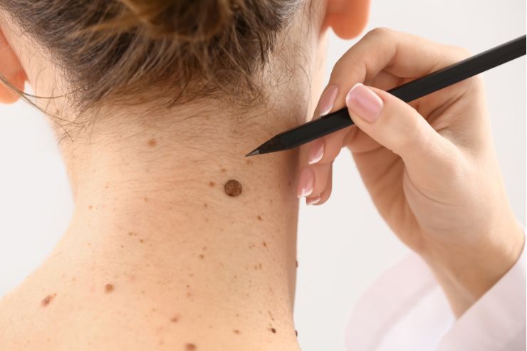 Mole and Skin Tag Removal